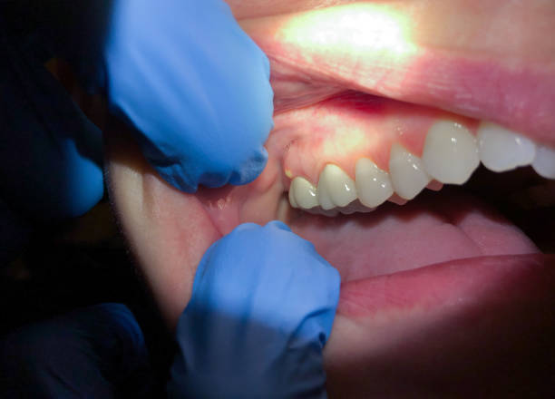Best Emergency Dentist for Lost Fillings or Crowns in Newport Beach, CA